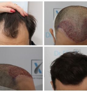 Transplant de păr la clinica Dr. Felix Hair Implant - o schimbare pozitivă vizibilă