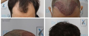 Transplant de păr la clinica Dr. Felix Hair Implant - o schimbare pozitivă vizibilă