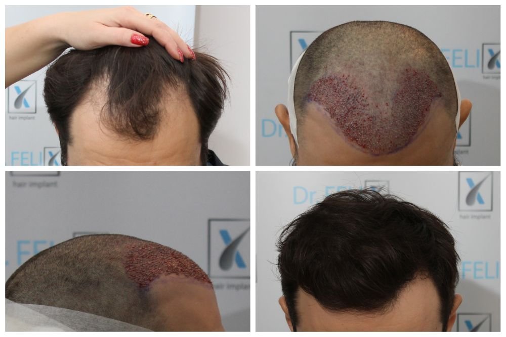 Transplant de păr la clinica Dr. Felix Hair Implant – o schimbare pozitivă vizibilă